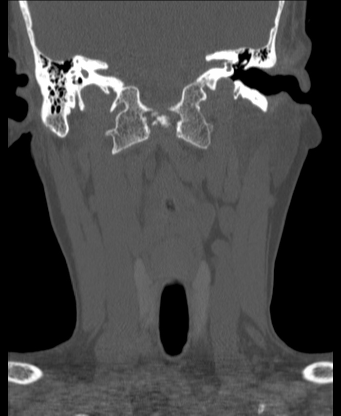 Atlanto-occipital assimilation with basilar invagination (Radiopaedia 70122-80188 Coronal bone window 53).jpg