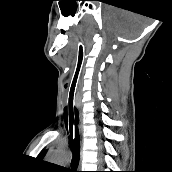 Atlanto-occipital dissociation (Traynelis type 1), C2 teardrop fracture, C6-7 facet joint dislocation (Radiopaedia 87655-104061 D 44).jpg