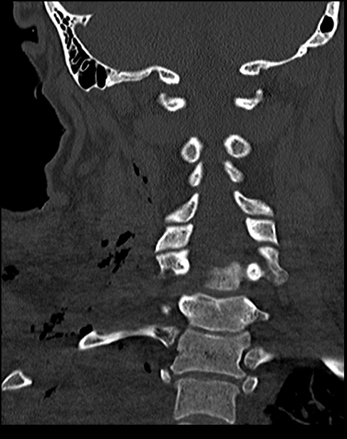 Atlanto-occipital dissociation - Traynelis type 1 (Radiopaedia 87570-103948 Coronal bone window 38).jpg