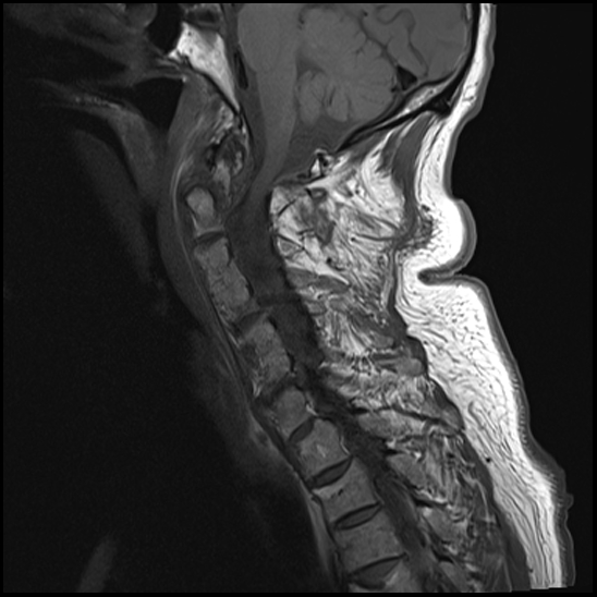 File:Atlas (type 3b subtype 1) and axis (Anderson and D'Alonzo type 3, Roy-Camille type 2) fractures (Radiopaedia 88043-104610 Sagittal T1 4).jpg