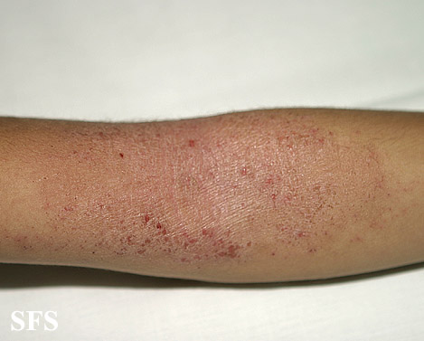 Atopic Dermatitis (Dermatology Atlas 25).jpg