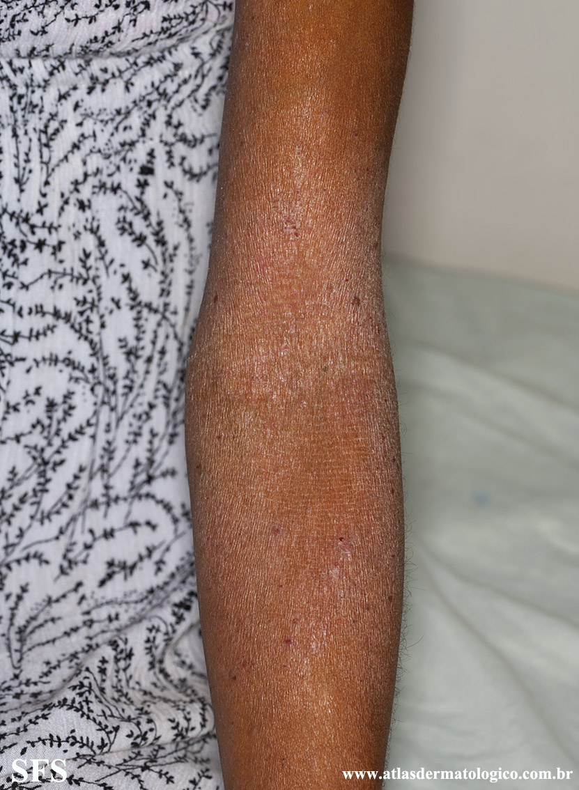 Atopic Dermatitis (Dermatology Atlas 38).jpg