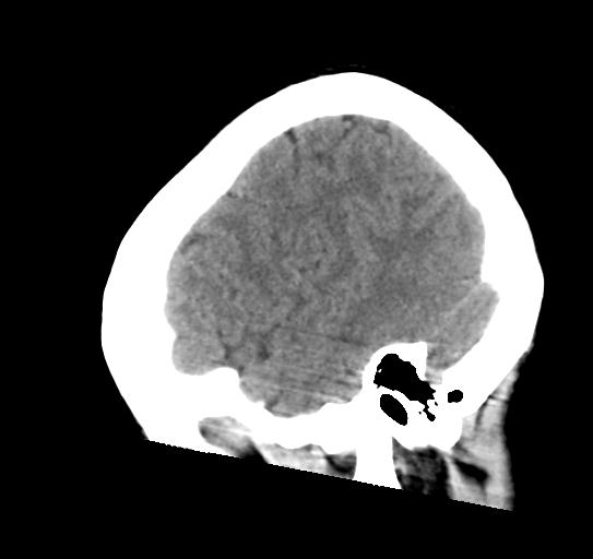 File:Atretic encephalocoele with inferior vermis hypoplasia (Radiopaedia 30443-31107 C 24).jpg