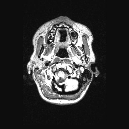 Atretic encephalocoele with inferior vermis hypoplasia (Radiopaedia 30443-31108 Axial 20).jpg