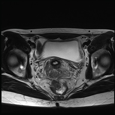 File:Atypical deep infiltrating endometriosis (Radiopaedia 44470-48125 Axial T2 19).jpg