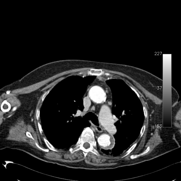 Atypical dissection of the thoracic aorta (Radiopaedia 10975-11393 A 24).jpg