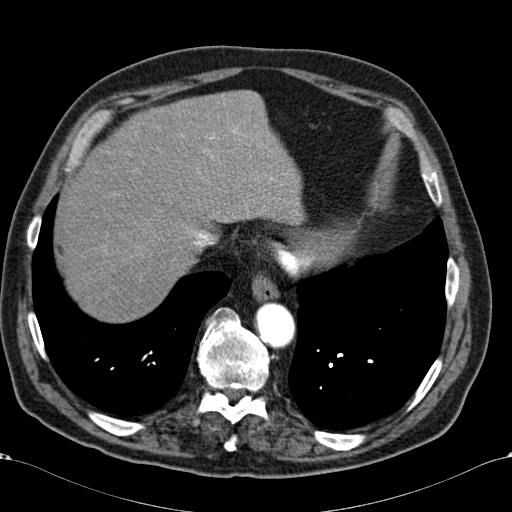 Atypical hepatocellular carcinoma (Radiopaedia 41744-44698 A 12).jpg