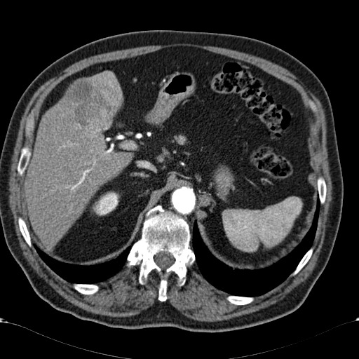 Atypical hepatocellular carcinoma (Radiopaedia 41744-44698 A 28).jpg