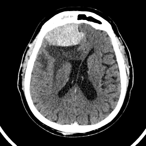 Atypical meningioma (WHO grade II) with brain invasion (Radiopaedia 57767-64728 Axial C+ 25).png