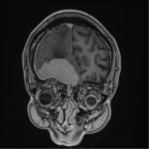 Atypical meningioma (WHO grade II) with brain invasion (Radiopaedia 57767-64729 Coronal T1 C+ 14).png