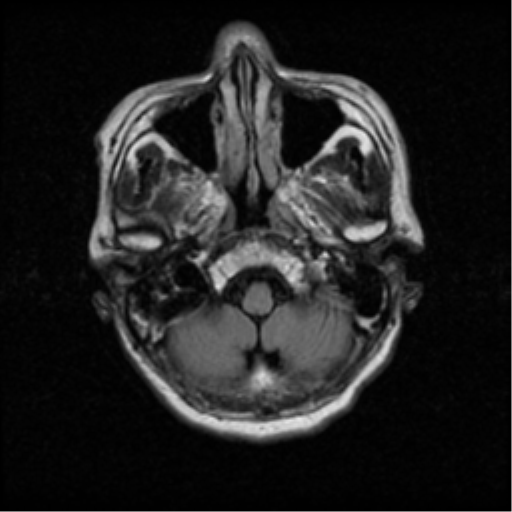 File:Atypical meningioma with skull invasion (Radiopaedia 34357-35648 Axial FLAIR 3).png