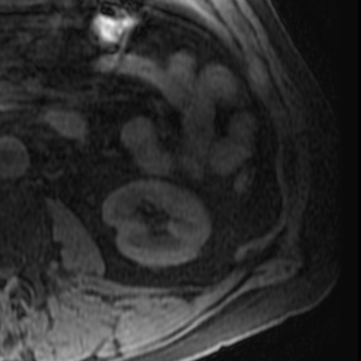 File:Atypical renal cyst on MRI (Radiopaedia 17349-17046 Axial T1 fat sat 23).jpg