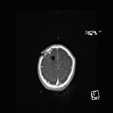 Atypical teratoid rhabdoid tumor (prenatal US and neonatal MRI) (Radiopaedia 59091-66388 Axial T1 C+ 53).jpg