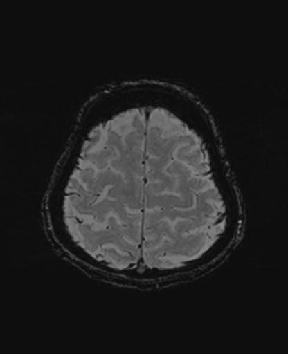 Autoimmune limbic encephalitis (Radiopaedia 30363-31005 SWI 68).jpg