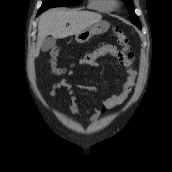Autosomal dominant polycystic kidney disease (Radiopaedia 36539-38101 C 16).jpg