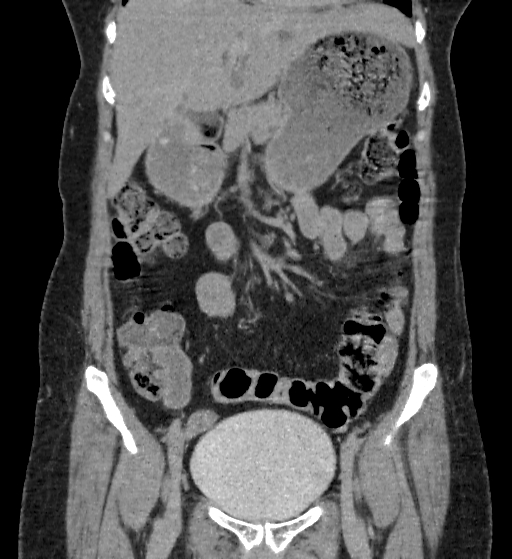 Autosomal dominant polycystic kidney disease (Radiopaedia 38189-40194 Coronal C+ delayed 24).jpg