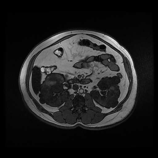 Autosomal dominant polycystic kidney disease (Radiopaedia 50259-55611 Axial 2D Dual Echo 47).jpg