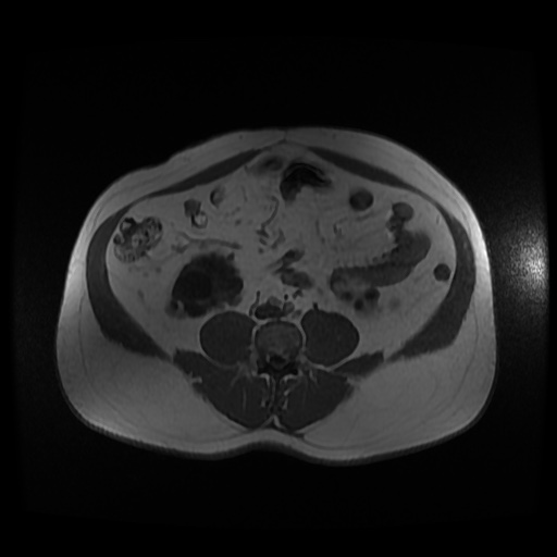 Autosomal dominant polycystic kidney disease (Radiopaedia 50259-55611 Axial 2D Dual Echo 68).jpg