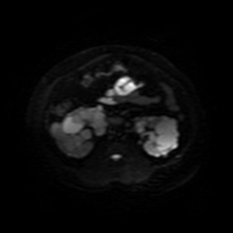 File:Autosomal dominant polycystic kidney disease (Radiopaedia 50259-55611 Axial DWI 25).jpg
