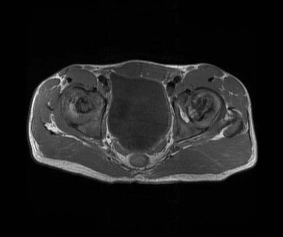 File:Avascular necrosis (Radiopaedia 11225-11590 Axial 1).jpg