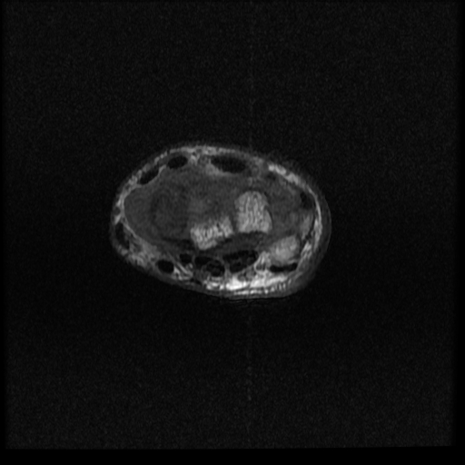 File:Avascular necrosis - scaphoid non-union (Radiopaedia 63457-72065 Axial T1 12).jpg