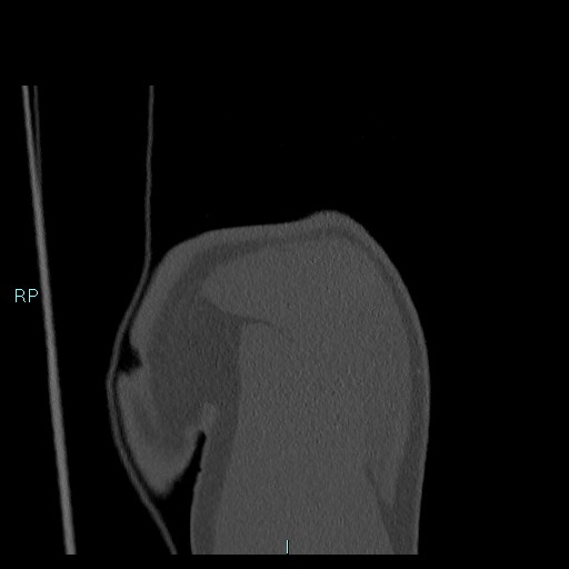 Avascular necrosis after fracture dislocations of the proximal humerus (Radiopaedia 88078-104655 Coronal bone window 31).jpg
