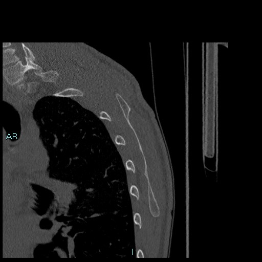 Avascular necrosis after fracture dislocations of the proximal humerus (Radiopaedia 88078-104655 Sagittal bone window 82).jpg