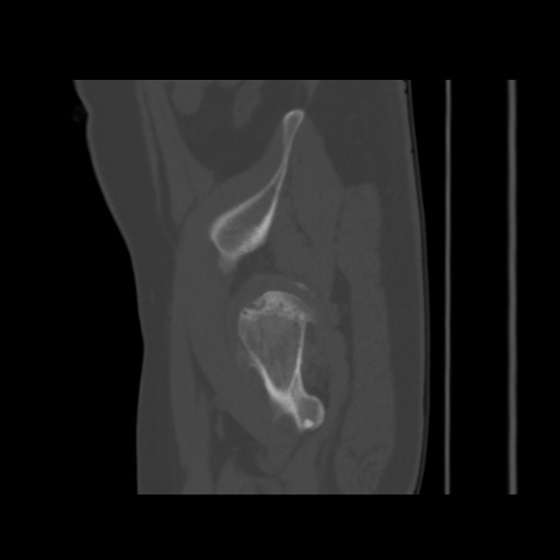 Avascular necrosis of the hip (Radiopaedia 61503-69467 B 51).jpg