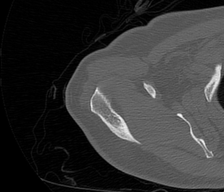Avulsion fracture - greater tuberosity of humerus (Radiopaedia 71216-81514 Axial bone window 17).jpg