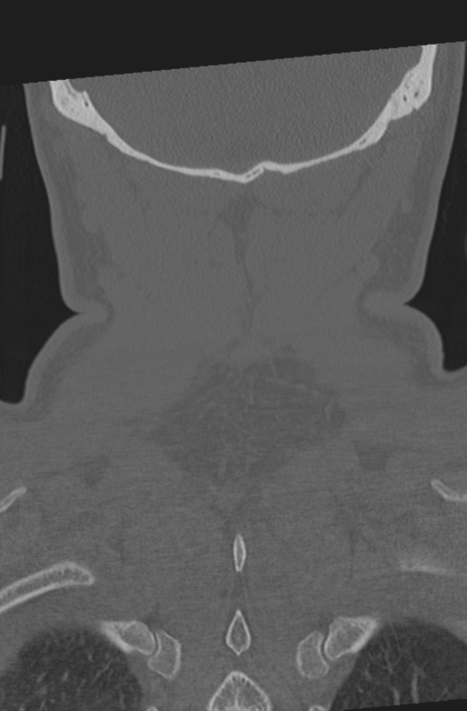 Axis peg fracture (type 3) and atlas lateral mass (type 4) fracture (Radiopaedia 37474-39324 Coronal bone window 57).png