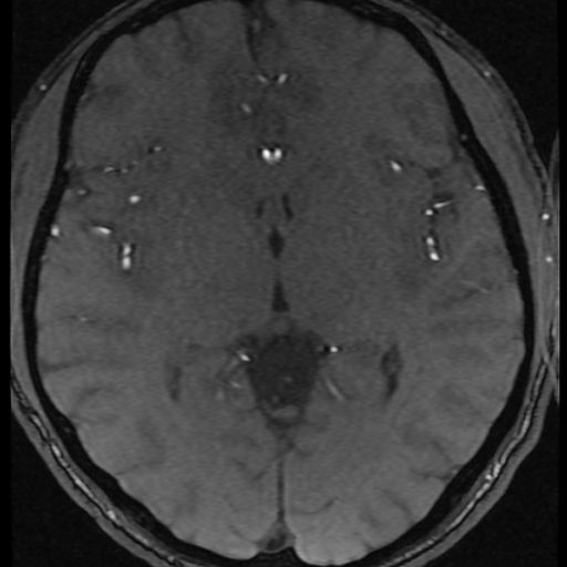 Azygos anterior cerebral artery (Radiopaedia 17059-16756 Axial MRA 19).jpg