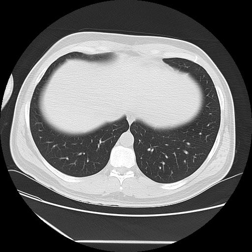 Azygos fissure (Radiopaedia 88181-104784 Axial lung window 43).jpg