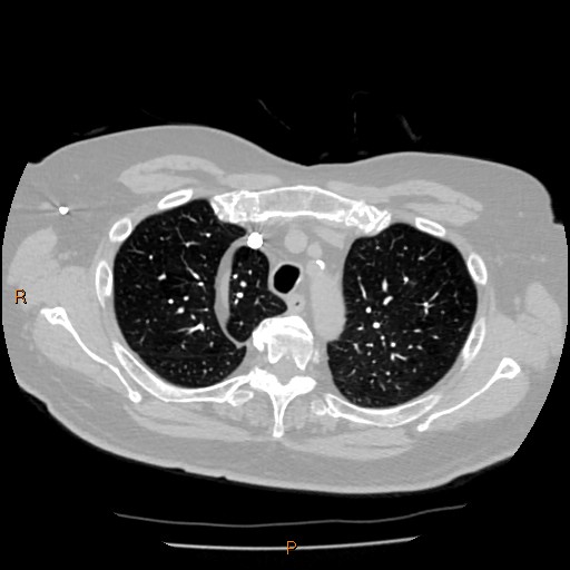 Azygos lobe (Radiopaedia 40161-42821 Axial lung window 12).jpg