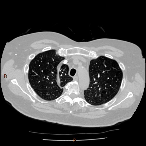 Azygos lobe (Radiopaedia 40161-42821 Axial lung window 14).jpg