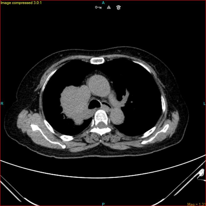 Azygos vein aneurysm (Radiopaedia 77824-90130 A 23).jpg