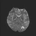 Balo concentric sclerosis (Radiopaedia 50458-55940 Axial DWI 34).jpg