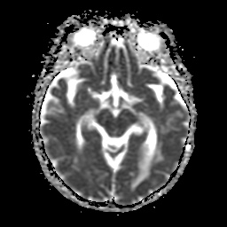 File:Balo concentric sclerosis (Radiopaedia 53875-59982 Axial ADC 11).jpg