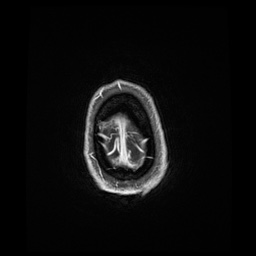 Balo concentric sclerosis (Radiopaedia 53875-59982 Axial LAVA C+ 249).jpg