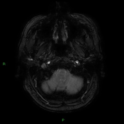 Basal ganglia hemorrhage (Radiopaedia 58346-65468 Axial SWI 5).jpg
