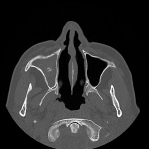 File:Base of skull chondrosarcoma (Radiopaedia 30410-31071 Axial bone window 9).jpg