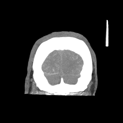 Basilar and bilateral vertebral artery occlusion (Radiopaedia 45592-49723 B 88).png
