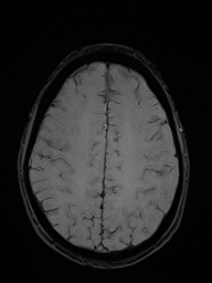 File:Basilar artery perforator aneurysm (Radiopaedia 82455-97733 Axial SWI 43).jpg