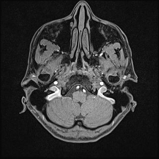 Basilar artery perforator aneurysm (Radiopaedia 82455-97733 Axial T1 fat sat 17).jpg