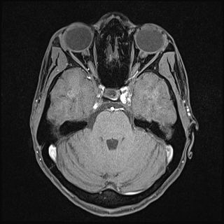Basilar artery perforator aneurysm (Radiopaedia 82455-97733 Axial T1 fat sat 49).jpg