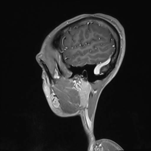 Basilar artery perforator aneurysm (Radiopaedia 82455-97733 G 127).jpg