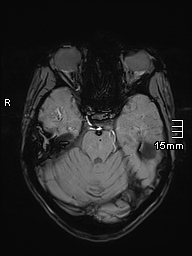 Basilar artery perforator aneurysm (Radiopaedia 82455-99523 Axial SWI 21).jpg