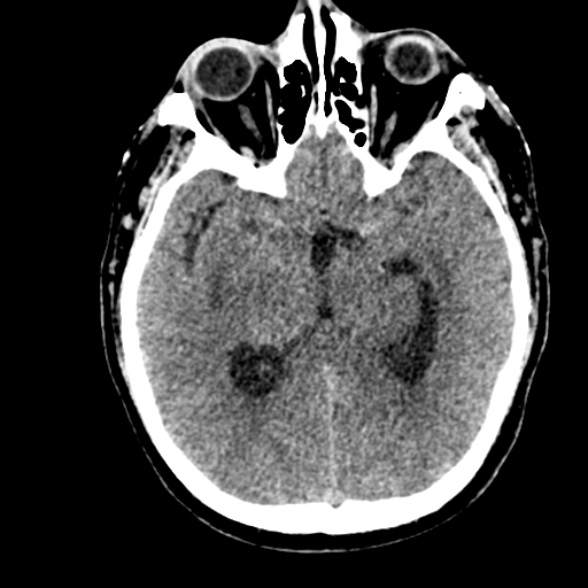 Basilar artery thrombosis (Radiopaedia 53351-59352 Axial non-contrast 58).jpg