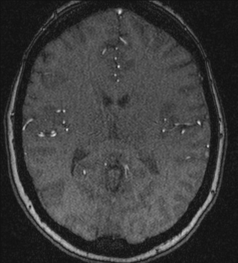 Basilar tip aneurysm (Radiopaedia 26504-26632 MRA 141).jpg