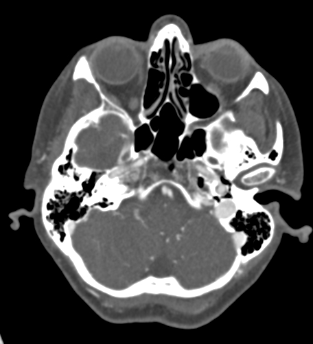 Basilar tip aneurysm with coiling (Radiopaedia 53912-60086 A 33).jpg