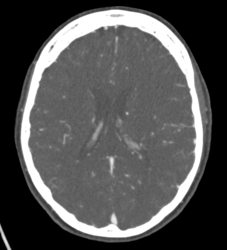 Basilar tip aneurysm with coiling (Radiopaedia 53912-60086 A 90).jpg
